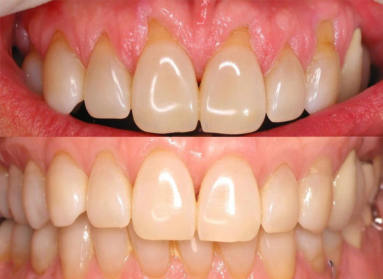 GumShield+™ - Den Naturlige Løsning til Sundt Tandkød