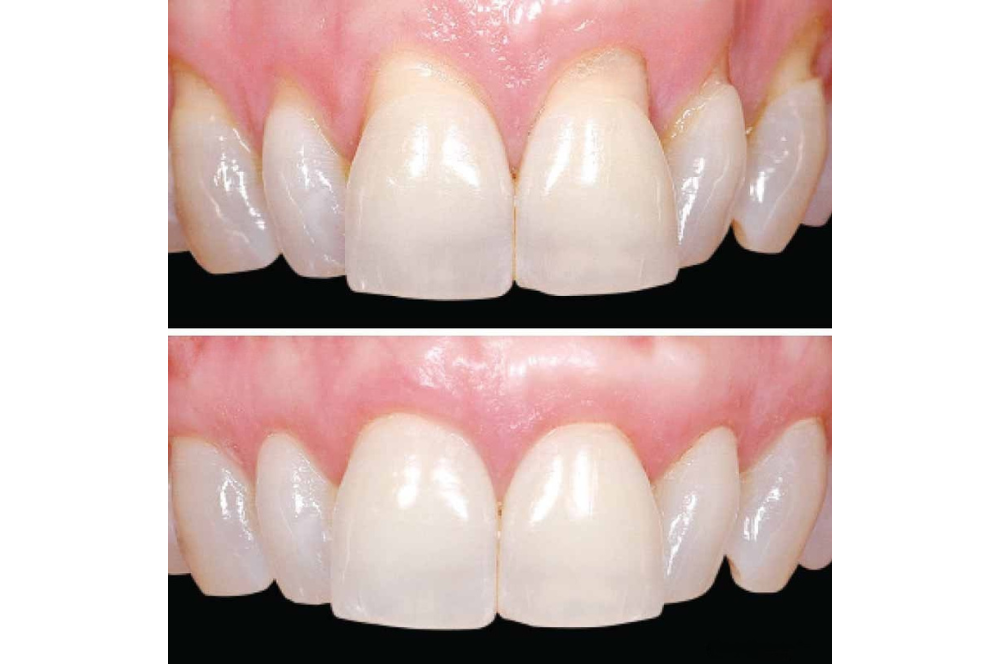GumShield+™ - Den Naturlige Løsning til Sundt Tandkød
